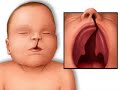 Cleft Palate