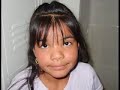 Cleft Palate