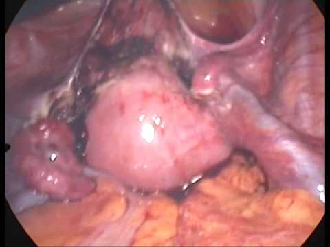 Total Abdominal Hysterectomy Procedure. easy laparoscopic total