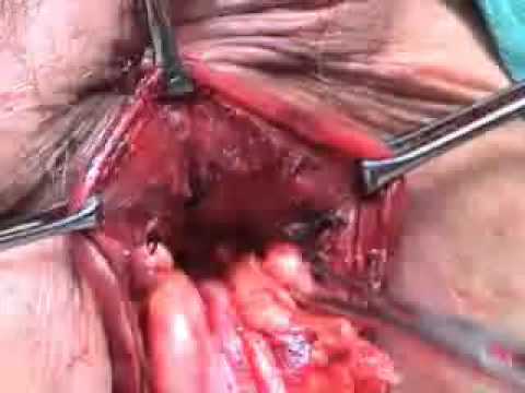 PERIANAL ABSCESS - http://studentsofmedicineplus.weebly.com http://www.facebook.com/Studentsofmedicineplus http://www.youtube.com/user/StudentsOfMedicineP This site is designed...