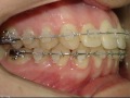 Ortodontia – Fechamento de Diastemas