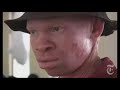Albino Killings in Tanzania Albino Killings in Tanzania