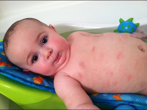 how to relieve eczema itching in babies