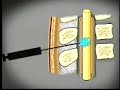 Lumbar Puncture#