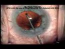 IFIS avoided by Intracameral Injection of Phenyl Epherine 10