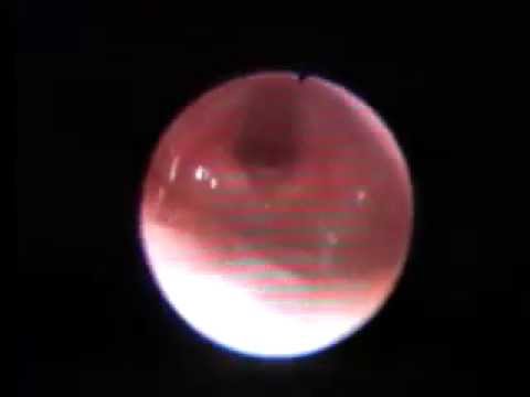 how to perform awake fiberoptic intubation