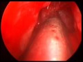 Sinus Surgery
