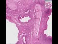 Histopathology Lung--Bronchiectasis