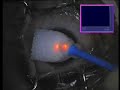 Keratoconus. Topography-guided PRK & UVACCL
