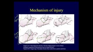 Calcaneal fractures - Anatomy, evaluation, classification (OTA lecture series IV L15a)