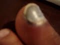 Nail diseases  Nails Nail Diseases