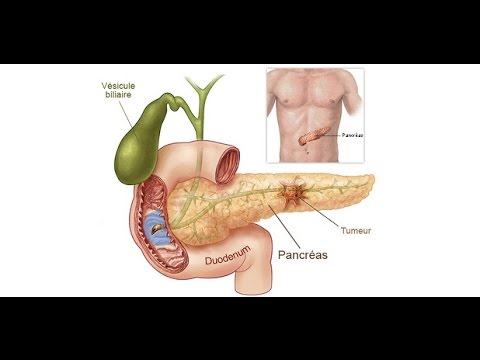 The mechanism of alcoholism causes acute pancreatitis