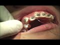 Indirect Bonding Initial Tie-In Part 4 Indirect Bonding Initial Tie-In Part 4