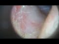 DinoLite Earscope Video