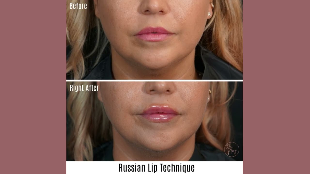 Russian Flat Lip Filler Technique