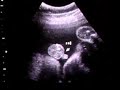 4D Ultrasound 28 Weeks Part 1