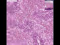 Histopathology Liver--Centrilobular necrosis from chloroform