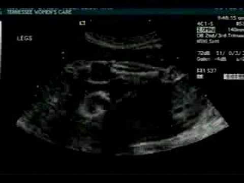 Baby Girl Hopkins Mark 2 Ultrasound ...