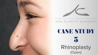 Case Study 5: Melissa (Open Rhinoplasty)
