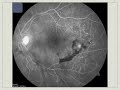 Diabetes Month Talk 2007 - Part 2 Diabetic Eye Disease