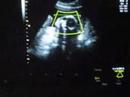 Fernadas - Ultra sound video - UCA 2008 - Part 4