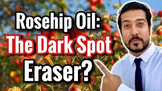 Rosehip Oil for Dark Spots in Melasma and Hyperpig