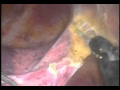 Pulmonary Adhesion - Procedure