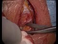Cervical microdiscectomy - Anterior approach