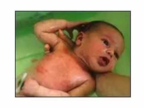 how to control eczema on baby face