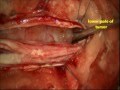 Spinal cord tumor-intra dural neurofibroma -microsurgical excision.-dr suresh dugani/HUBLI/INDIA