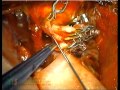 Morcos Webinar Video Case 3 - Double reimplantation bypass for recurrent giant MCA aneurysm.mov