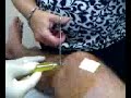 Draining of  synovial fluid & cortisone shot in the knee