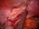 Laparoscopic supracervical hysterectomy(LSH)