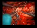 Bypass for Complex Basilar Aneurysms