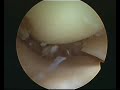 Mi operacion del menisco derecho. Pforzheim Alemania Mi operacion del menisco derecho. Pforzheim Alemania