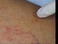 Foam sclerotherapy to remove leg veins Foam sclerotherapy to remove leg veins