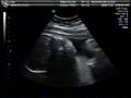 ultrasound 081122.avi