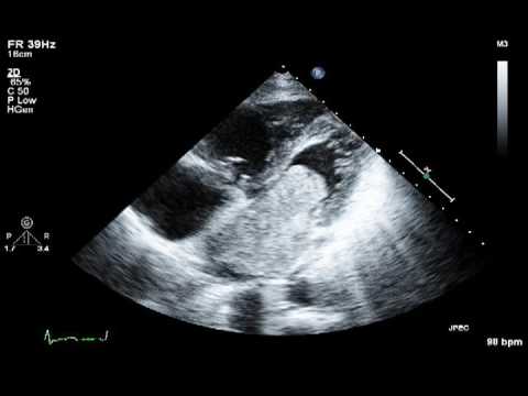 echocardiogram