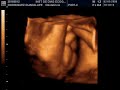 VALENTIN NICOLAS 33 SEMANAS Y 4 DIAS DE GESTACION 02-05-08