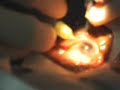Love In Action Clinic - Opthamology Cataract Surgery