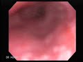 Endoscopia de Es�fago de Barrett con magnificaci�n