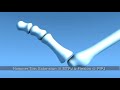 Hammer Toe Surgery Explained Podiatry Claw Toe Mallet Toe
