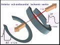 Reciprocal ST elevation in Unstable angina Reciprocal ST elevation in Unstable angina