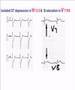 Reciprocal ST elevation in Unstable angina