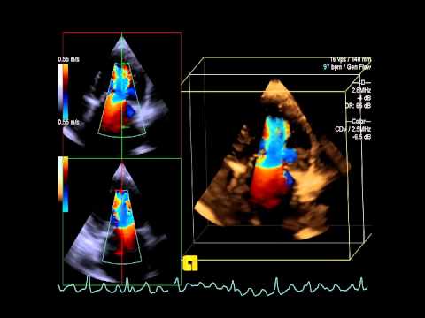 how to measure mr vena contracta