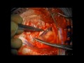 Brain Surgery - Large Arachnoid Cyst