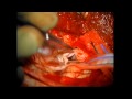 Brain Surgery - Large Arachnoid Cyst