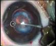 Congenital cataract with natural PCCC