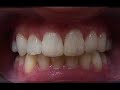 Ortodoncia fija y blanqueamiento dental Ortodoncia fija y blanqueamiento dental