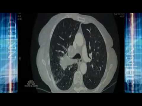 how to cure lung cancer